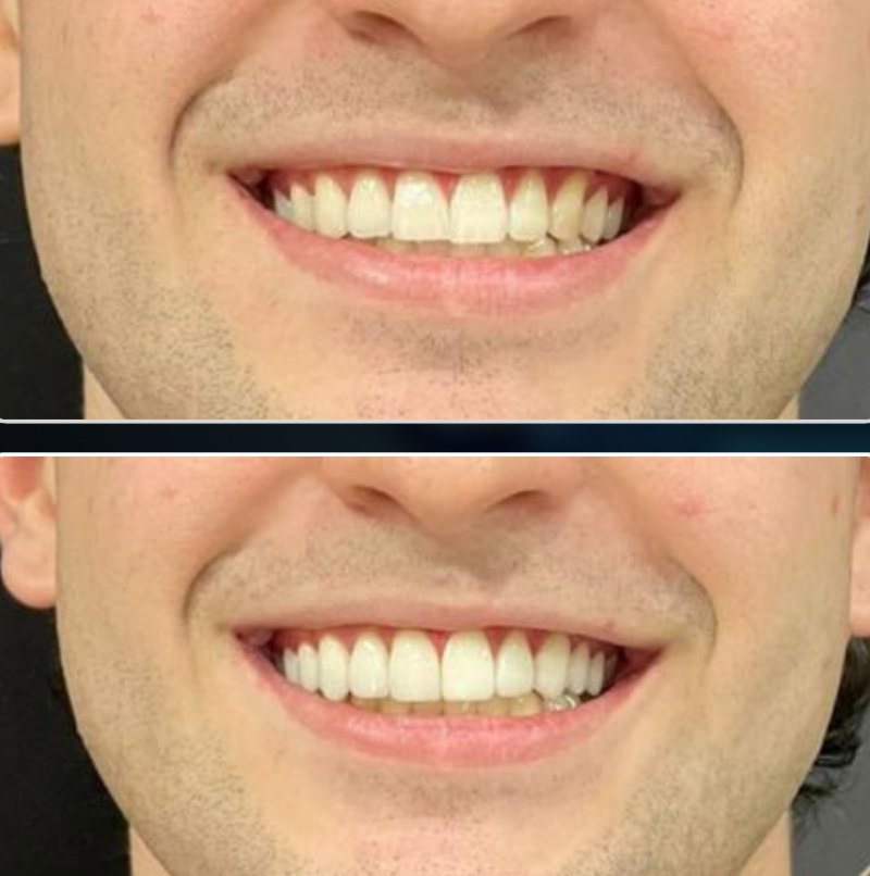 Transformação 1: sorriso antes (acima) e depois (abaixo) do tratamento