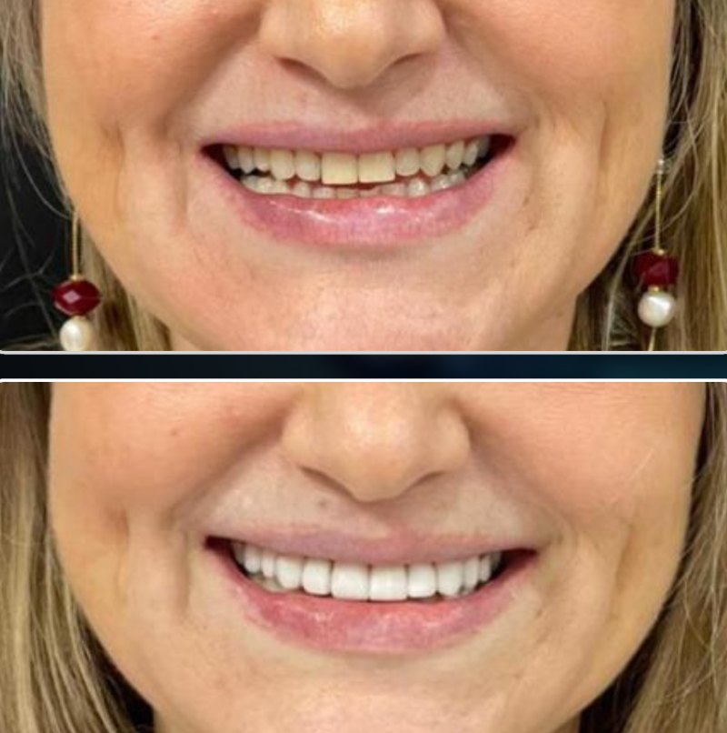 Transformação 2: sorriso antes (acima) e depois (abaixo) do tratamento