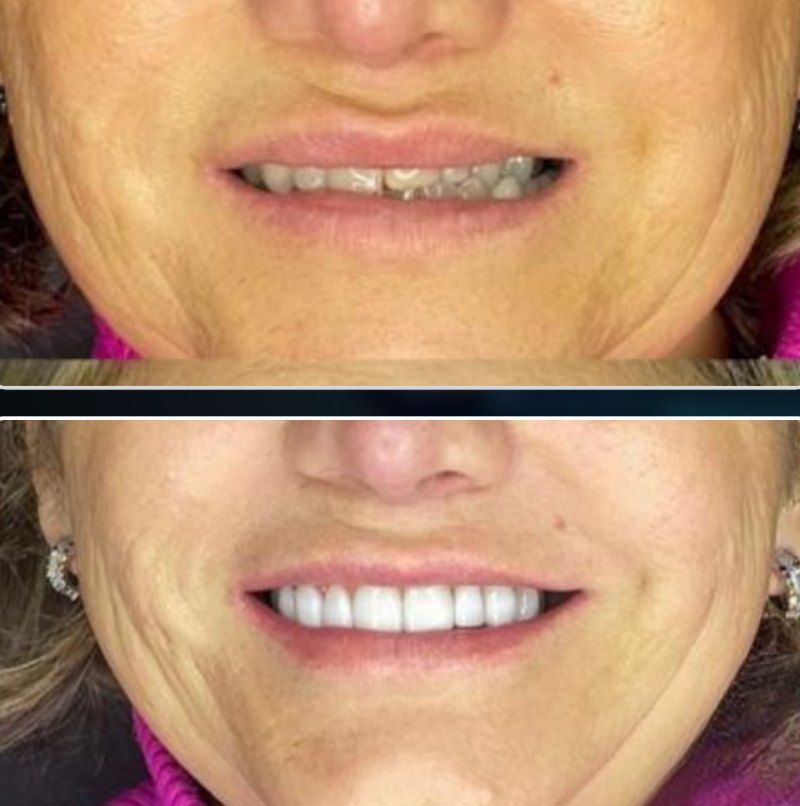 Transformação 3: sorriso antes (acima) e depois (abaixo) do tratamento