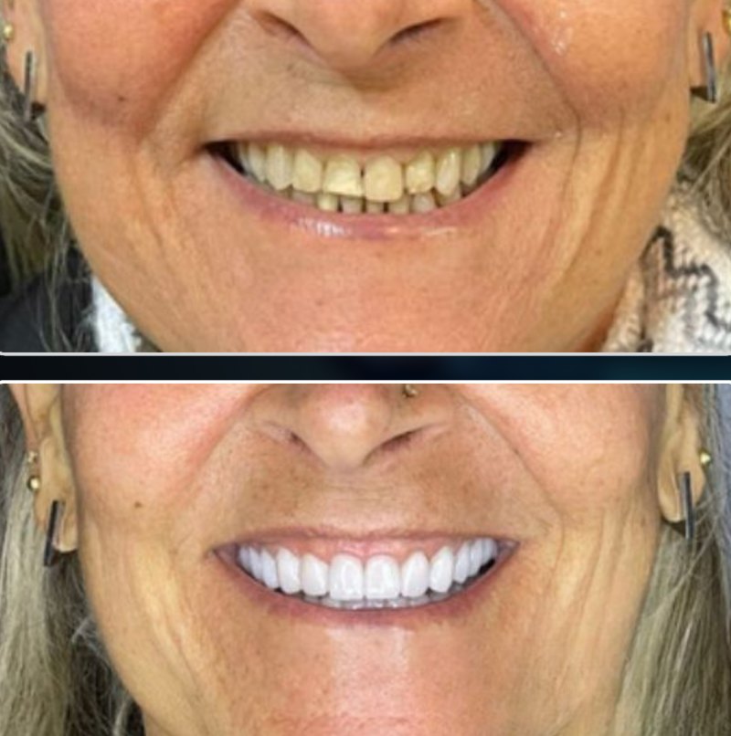 Transformação 4: sorriso antes (acima) e depois (abaixo) do tratamento