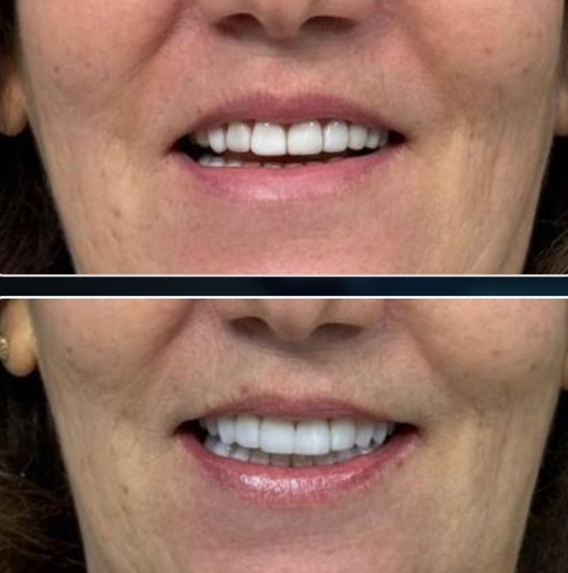 Transformação 5: sorriso antes (acima) e depois (abaixo) do tratamento