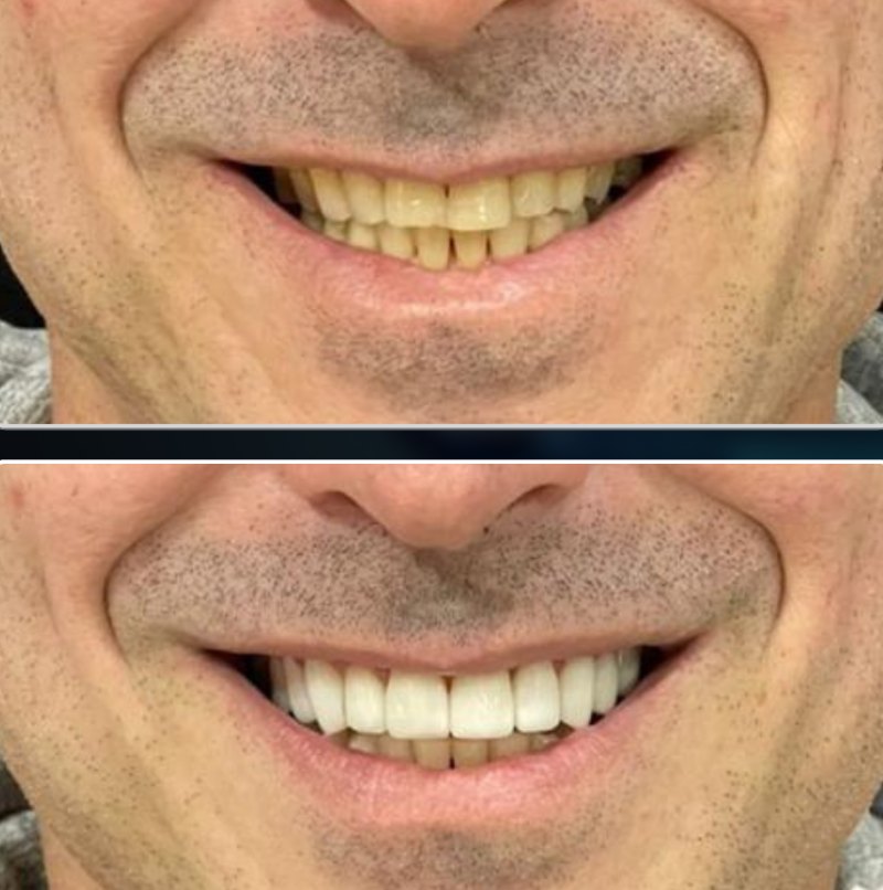 Transformação 6: sorriso antes (acima) e depois (abaixo) do tratamento