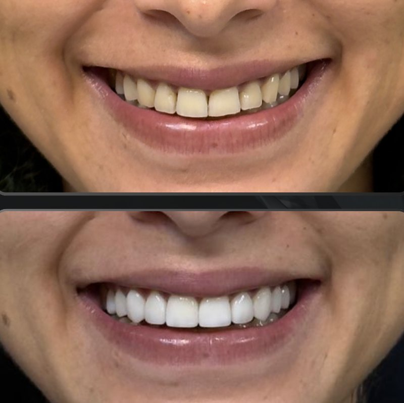 Transformação 7: sorriso antes (acima) e depois (abaixo) do tratamento