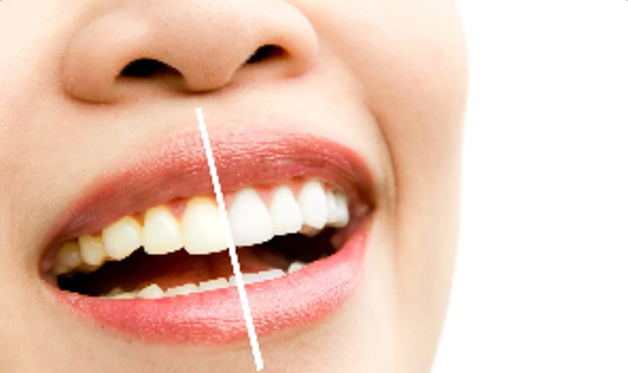 Sorriso mostrando a diferença de cor antes e depois do clareamento
