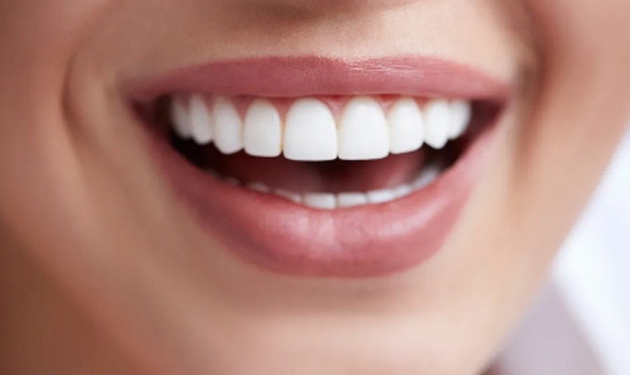 Sorriso com lentes de porcelana