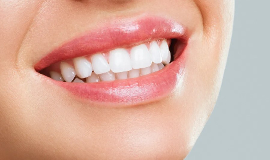 Sorriso feminino com lentes de resina